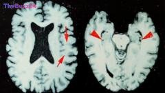 Alarming Study Reveals Nearly All Deceased NFL Players May Have Suffered Brain Disease