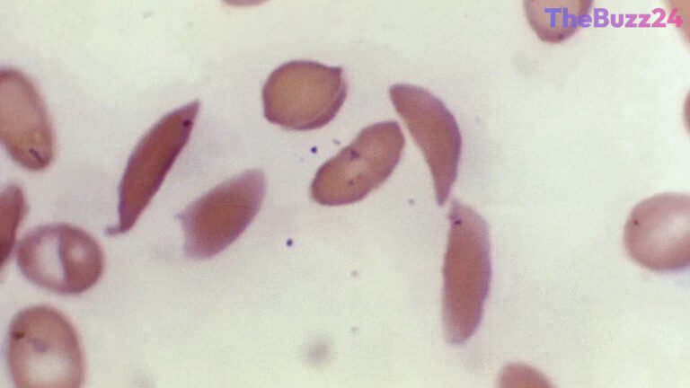 Breakthrough Sickle Cell Gene Therapies Promise Cures but Face High Costs and Access Barriers